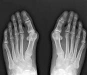 하이힐병? 무지외반증 남성도 안심 마세요