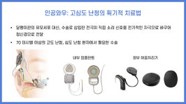 난청이 이명도 유발… 보청기·인공와우로 청각재활해야