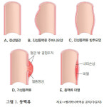 갑자기 발생하는 극심한 두통과 흉통, 어떻게 위험한가요? [의사에게 듣는 질환 이야기]