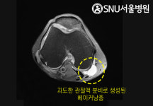 오금 통증 일으키는 무릎 안의 물혹, 관리 방법은? [한도환의 무릎 이야기]