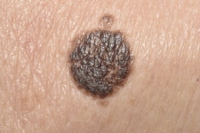 십 년은 더 늙어보이게 하는 검버섯, 양성종양이라고?