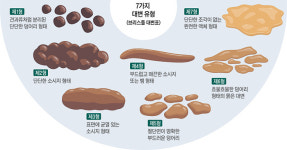 大便은 건강 바로미터… 잘 보고 계신가요?