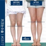 사지연장술 그 화려한 변신 속에 감춰진 부단한 노력 [정형외과의 미용적 수술, 사지연장술 & 휜다리수술]
