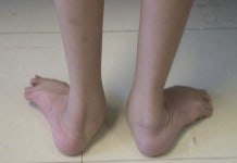 소아 재활은 티끌모아 태산… 장기전으로 생각해야 [헬스조선 명의]