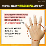 [카드뉴스] 동남아 여행 다녀온 후 손에 이 증상 생기면 병원 가세요