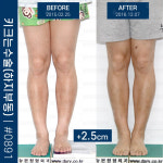 양다리 길이 다른 ‘하지부동’에게 사지연장술이란? [정형외과의 미용적 수술, 사지연장술 & 휜다리수술]