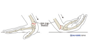 손목 골절 (원위 요골 골절) 의 합병증 [곽상호의 손·손목 이야기]