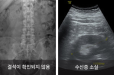 요관 내시경 결석 제거술, 꼭 해야 하는 경우는? [아는만큼 젊어지는 비뇨기 질환 이야기]