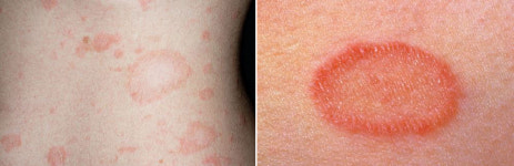 갑자기 복부에 나타난 붉은 반점… 피부 감기, 이 질환 의심해야