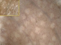 입술에 흔한 하얀 점, 남성 음경에도 생긴다는데… 성병 때문일까?