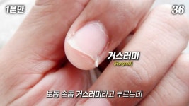 손톱 옆에 일어난 ‘흰 가시’… 제대로 제거하는 법