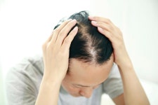 M자형 탈모, O자형 탈모… 사람마다 머리 빠지는 모양 다른 이유는?