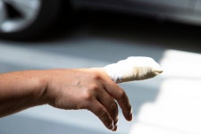 “손가락 멀쩡하지만 잘라주세요”… 스스로 장애인 되고자 하는 정신질환, 대체 왜?