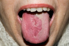 코로나 감염, 이제 얼룩덜룩 혀로 나타난다?