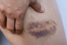 최근 들어 몸에 잘 생기는 멍… 가장 먼저 이것 의심해 보세요