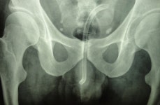 요도에서 나온 기다란 물체… 30대 男 스스로 집어넣었다는데, 대체 왜?