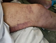 수 세기 전 유행하던 ‘이 병’ 다시 등장… 붉은 반점이 의심 신호?