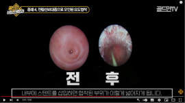 실제 수술 사례로 알아보는 전립선비대증·방광결석·요도협착 치료 방법 [비뇨기 3분 클리닉]