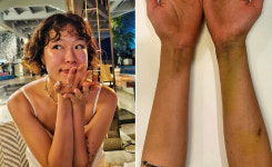 ‘스우파’ 효진초이, “팔에 멍 한가득” 투병 근황 전해… 무슨 일?