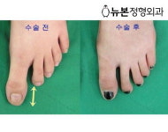 손·발가락 단지증, 의외로 흔하고 스트레스 심각해 [정형외과의 미용적수술, 사지연장술, 휜다리수술]