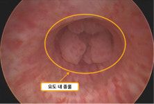 재발 확률 더 높은 요도·항문 곤지름… 제대로 치료하려면? [비뇨기 3분 클리닉]