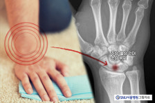 손목 주상-월상 골간 인대 손상, 만성 통증이 있는데 손목 흔들린다면? [곽상호의 손·손목 이야기]
