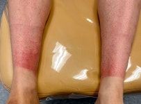 이 운동 10년 한 결과?… 美 40대 남성, 빨간 반점 잔뜩 올라온 의외의 이유?