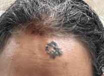 7년 전 생긴 이마 점, 방치했는데… 뒤늦게 알게 된 충격적 정체는?