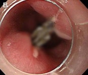 “자칫하다간 식도 관통”… 생각보다 위험한 ‘이 반찬’, 정체는?