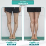 오다리만 고쳐도 키가 커질 수 있다 [정형외과의 미용적수술, 사지연장술, 휜다리수술]