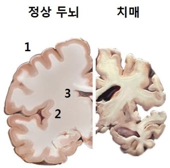 수면 부족→뇌세포 해마 고장→단기기억 상실→치매