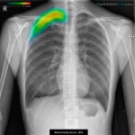 루닛, 폐 질환 검출 AI  식약처 허가