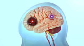 치료해도 증상 남는 뇌졸중 비밀 밝혀… “기술 이전 신약 효능 확인”