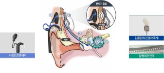 [메드테크, 우리가 국대다]③ 반도체 공정이 귀로 들어왔다, 첫 국산 인공와우