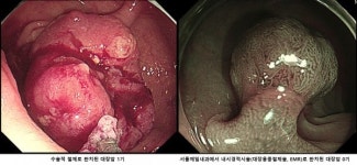 증상 없는 대장암, 주기적인 대장 내시경 검사로 예방해야 [건강 올레길]