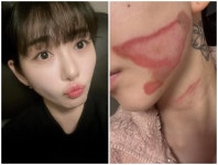 권민아, 피부과 시술 도중 의료 사고 당했나...SNS 게재 사진 ‘충격’