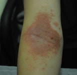 아토피 면역체계 확립을 통한 자연적인 치료가 최선