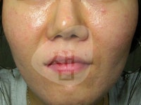 심한 피지에 홍조·각질 증상까지 있다면?…지루성피부염 아냐?