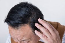 [헬스S] 호환 마마보다 무서운 가을 탈모… 소중한 머리카락 지키려면