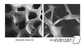 양구군 장애인 골다공증 무료검사