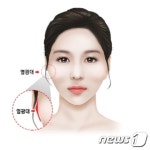 옆광대수술, 빠른 수술 시간만큼 회복기간 줄여