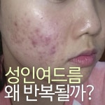 성인여드름, 한의원에서는 어떻게 치료할까?