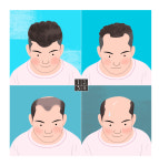 ‘남성 탈모엔 잘 먹어야…’ 탈모 예방에 효과적인 식품