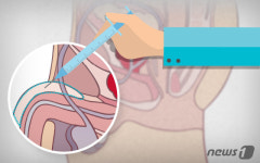 말못할 고민에 비뇨기과 찾는 남성들…음경확대술 안전할까