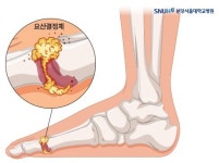 [생생 건강정보] 극심한 통증 남성 위협하는 통풍…고기·맥주 피하세요