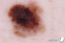 [100세건강] 점이 왜 이리 많이 생겼지…혹시 나도 피부암?