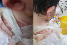 화상 입은 아이, 도와주세요 확진 아빠 애끓는 호소에 도움 손길 이어져