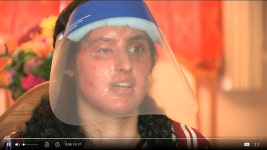 왜 하필 나였나…염산 맞고 카메라 앞에 선 인종증오 피해자