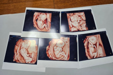 국내 첫 자연임신 다섯쌍둥이 탄생…세계적으로 드물어