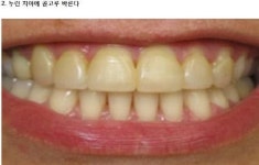 SNS서 인기 초간단 치아미백법…정말 효과 있을까?